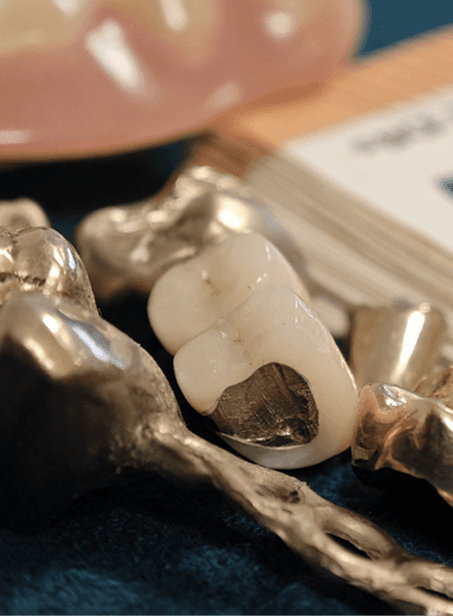 Zahngold Ankauf in Rendsburg bei Goldankauf Johannsson Portfolio